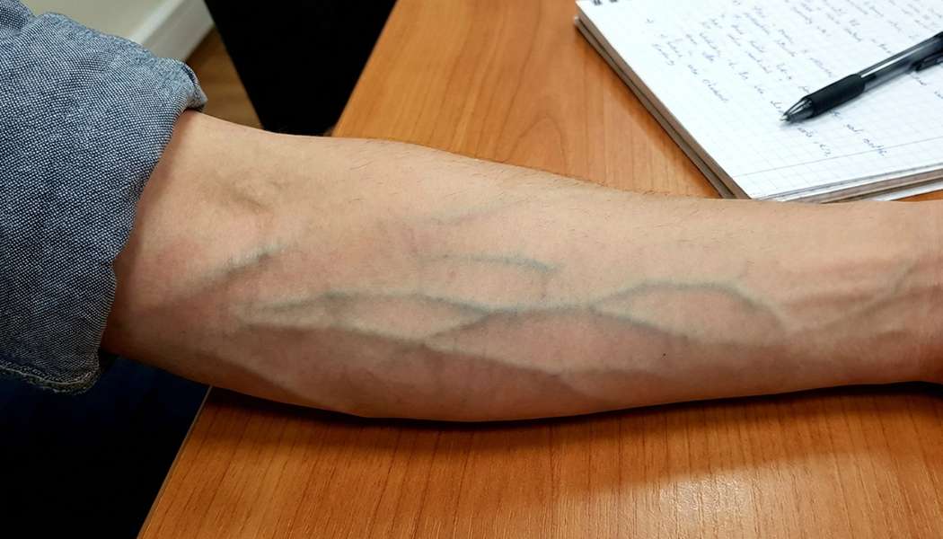 VASCUNYL : une autre approche de la circulation veineuse